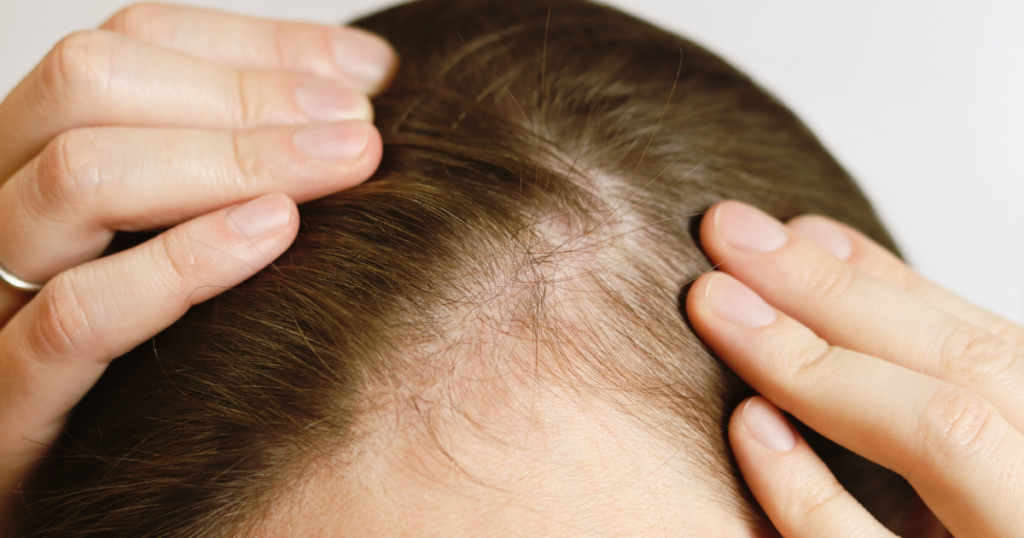 前髪が薄い、分け目が気になり始めた40代50代女性のための頭皮と髪の悩みをイメージした写真