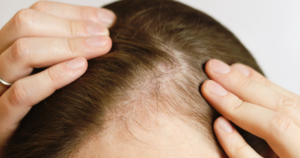 前髪が薄い、分け目が気になり始めた40代50代女性のための頭皮と髪の悩みをイメージした写真